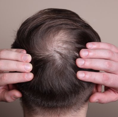 Recuperación de 
pelo técnica FUE